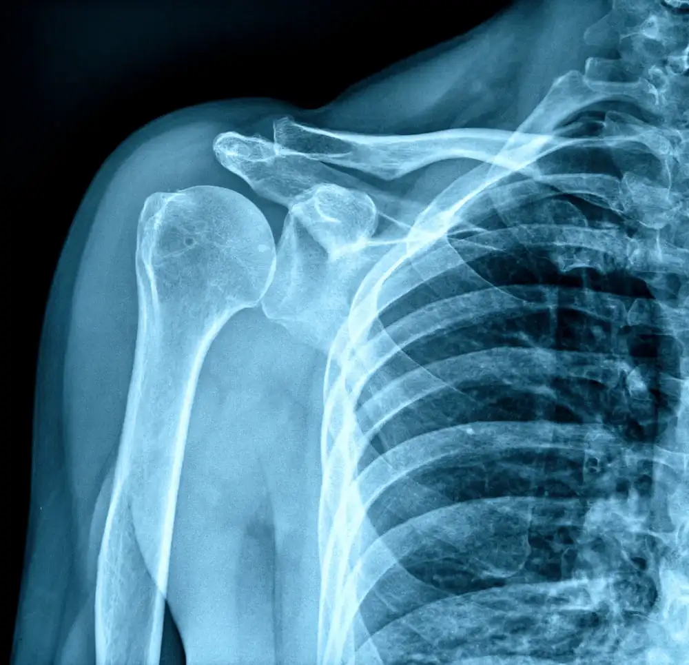 Shoulder x-ray