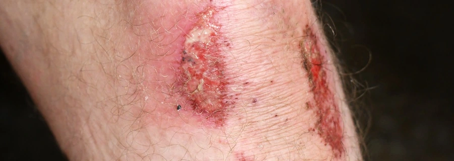 A person got a road rash after being in a motorcycle accident.